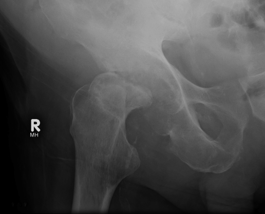 Hip OA Post Sepsis